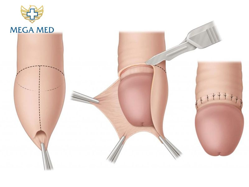 chưa lột bao quy đầu quan hệ được không